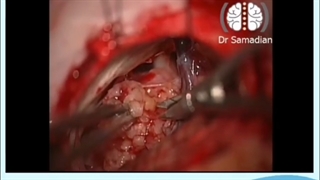 عمل جراحی شوانوم سی پی انگل