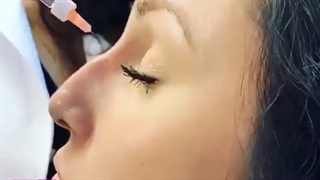 اصلاح قوز بینی