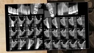 جراحی دندان عقل