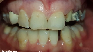 بهترین روکش و لمینت دندان(دکتر بهمن پوراقدم)0212220000