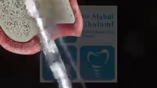 ویدئو جذاب از جراحی کاشت ایمپلنت ( دکتر مهدی غلامی)