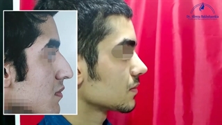 جراحی زیبایی بینی