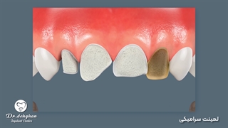 دکتر وحید دهقان  : لمینت سرامیکی