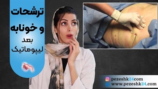 تخلیه خونابه بعد از لیپوماتیک ، آیا ترشح خونابه بعد از لیپوماتیک خطرناک است؟