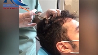 فیلم واقعی مزوتراپی مو
