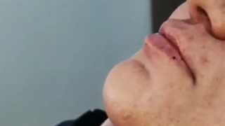 تزریق حجم کم ژل لب با توجه به سلیقه مشتری