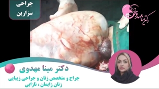 موضوع: جراحى سزارین