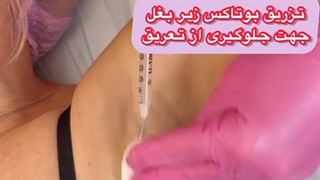 بوتاکس زیر بغل