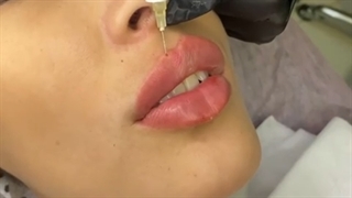 تزریق ژل لب روسی