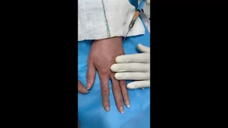 نمونه کار تزریق چربی به دست در کلینیک دکتر لاغری جراحی بینی