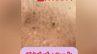 درآوردن موی زیر پوستی
