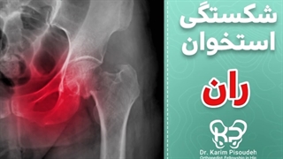 درمان قطعی شکستگی استخوان ران