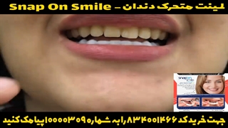 خرید لمینت متحرک دندان اسنپ آن اسمایل-09363660478