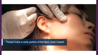 معرفی ۱۱ روش مدل و معجزه گر لیفت صورت