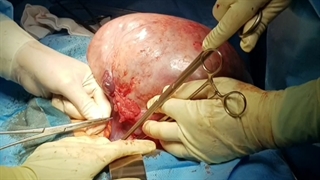 خارج کردن توده تخمدان