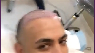 هزینه و مزایای کاشت مو به روش SUT (اس یو تی)