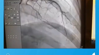 سندرم قلب شکسته