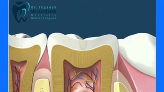 پوسیدگی دندان