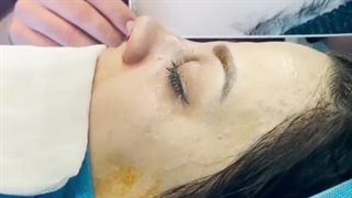 جراحی زیبایی بینی و نتیجه آن در اتاق عمل