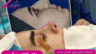 جراحی زیبایی بینی با رفع افتادگی و برآمدگی