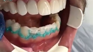 لامینیت ونیر+بلیچینگ