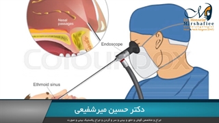 آندوسکوپی سینوس