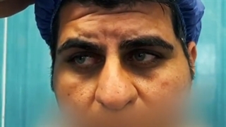 لیفت اندوسکوپی ابرو و عمل بینی همزمان