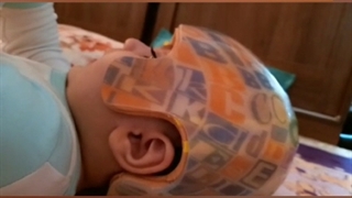 کلاه فرم دهی سر نوزاد - ساخت کلاه طبی برای اصلاح فرم سر نوزادان | کلینیک پژم