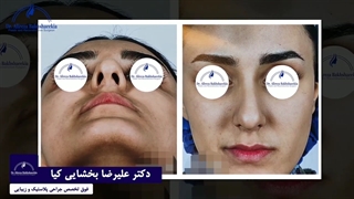 جراحی زیبایی بینی