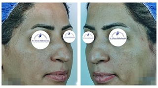 جراحی زیبایی بینی