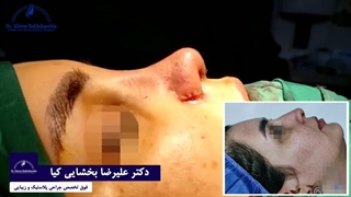 جراحی زیبایی بینی