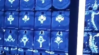 استخوانی شدن تاندون های پشت مهره ها