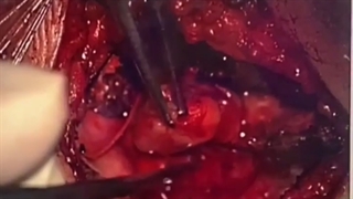 جراحی تومور شوانوما