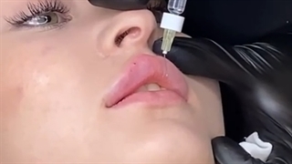 تزریق ژل لب با متدد روسی