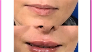 عوارض احتمالی تزریق ژل در نواحی مختلف صورت و بدن دکتر پوست