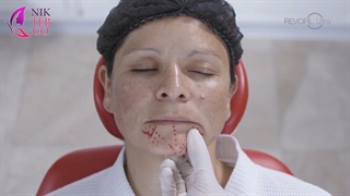 ژل رووفیل اولترا