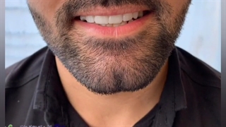 درمان ترکیبی لمینت سرامیکی ایمکس .. ایمپلنت