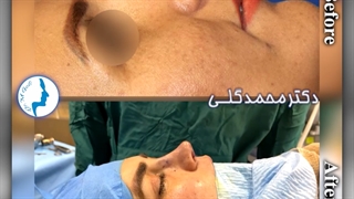 قبل و بعد از جراحی زیبایی بینی | دکتر گلی