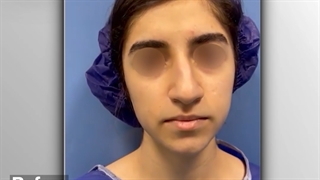 قبل و بعد جراحی زیبایی بینی | دکتر خوروش