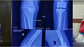 رضایت جراحی تعویض مفصل زانو