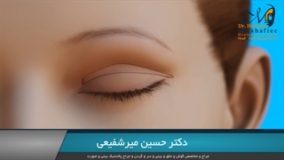 همه چیز درباره بلفاروپلاستی (جراحی زیبایی پلک)