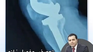 همه چیز درباره تعویض مفصل زانو