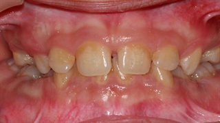 ارتودنسی نیش نهفته | دکتر داودیان