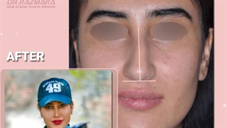 یک سال بعد از جراحی بینی