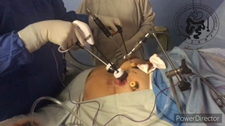 عمل اسلیو معده در بیمار نوجوان 190 کیلوگرمی