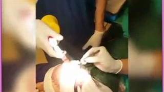 هزینه،معایب و مزایای کاشت مو به روش سوپر ترکیبی