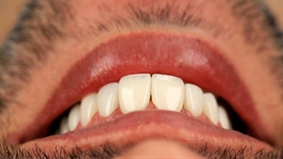 ایمپلنت و لمینت دندان (دکتر یلدا بازرگان)02122220000