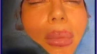 عوارض جراحی پلک