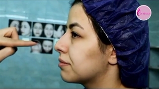 رضایت مراجعه کننده عزیز بلافاصله بعد از باز کردن گچ بینی