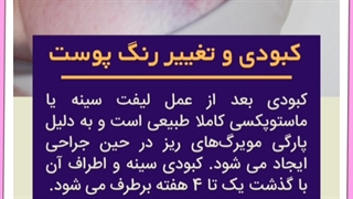 هزینه ،مراحل و روش های لیفت سینه